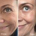 Prima e dopo riduzione rughe contorno occhi e diminuzione cellulite